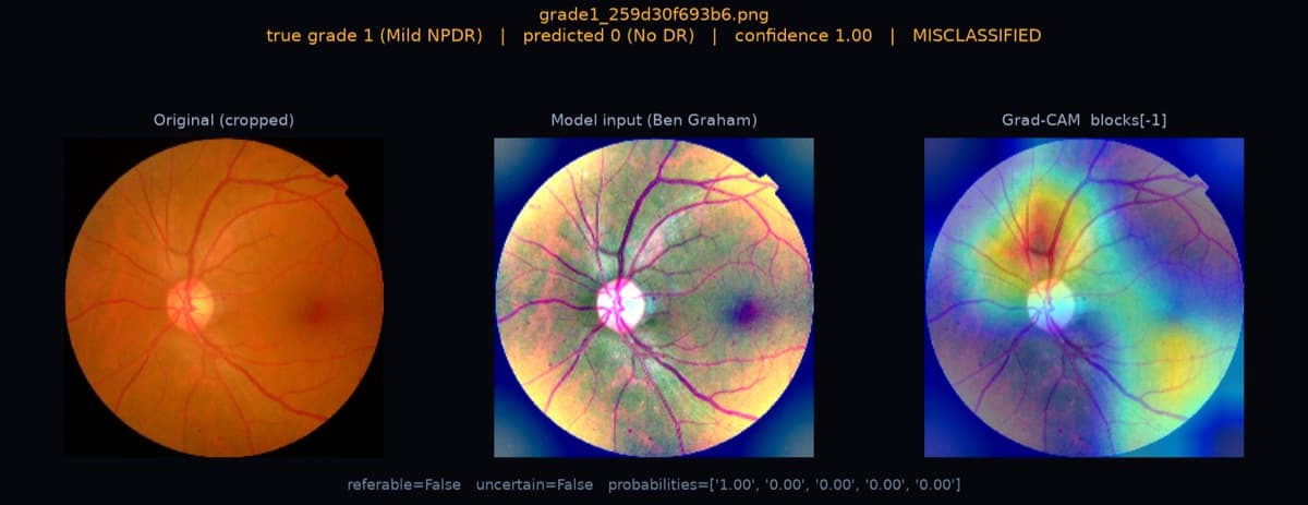 Grad-CAM evaluation panel for a scan the model graded incorrectly